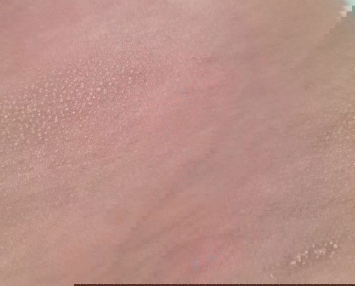 Kulit bayi bintik" kering