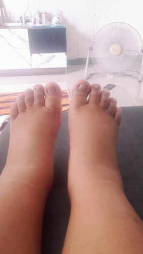 หมอนัด27ธันวา แต่ตอนนี้35w แล้ว บวมมากเลยค่ะ จะถึงกำหนดรึป่าวไม่รุ้ค่ะ