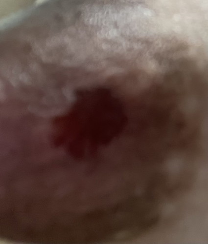 nipple itch and dark/red spot around areola