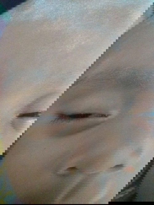 Kelopak mata bercak putih