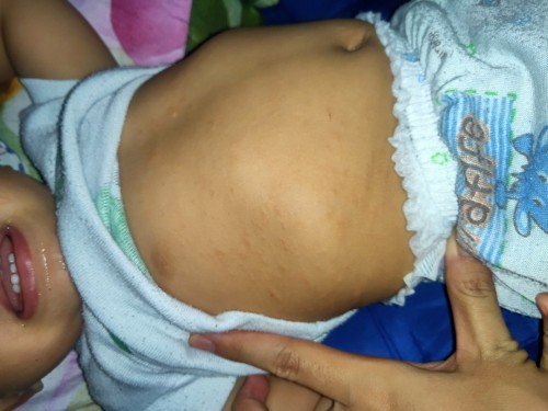 bentol di badan bayi