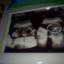 Bunda ini hasil usg saya kehamilan 18week tapi beluum kelihatan jelas mukanya,ada yang sama gak