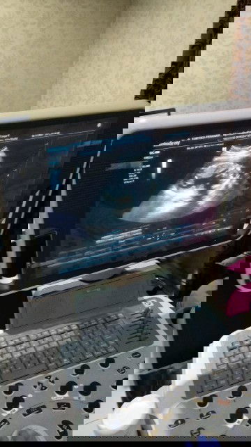 Panjang janin kurang