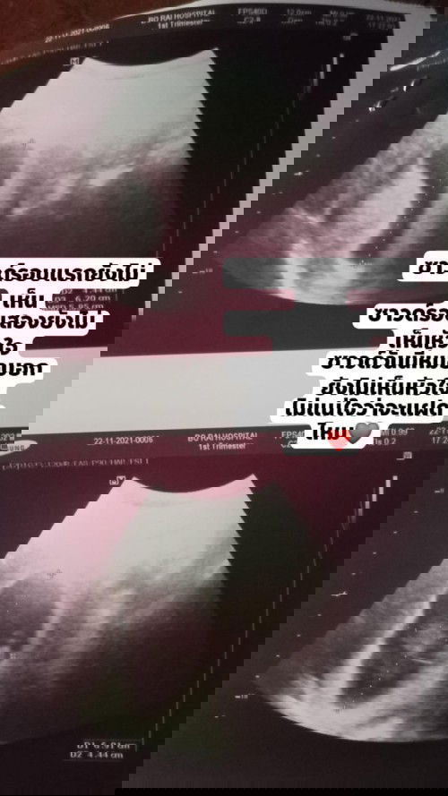 ขอสอบถามแม่ๆหน่อยคะว่าทำไมซาวด์ไม่เห็นหัวใจคะ