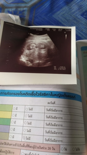 อัลตร้าซาวด์11w3d
