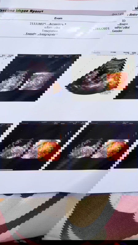 อัลตร้าซาวด์เพศลูก