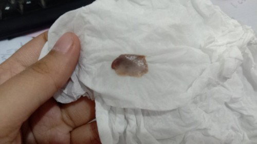 Keluar gumpalan kaya daging usia kandungan 27 minggu