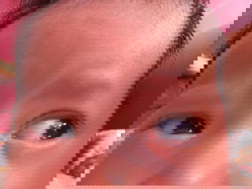 Mata bayi alergi atau ?