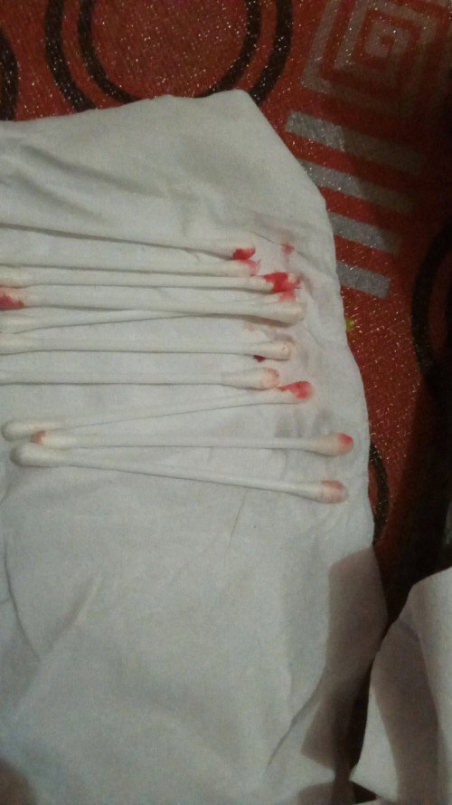 Hai bunda apakah pernah mengalami apa yang di alami oleh saya...saya batuk keluar darah dari telinga