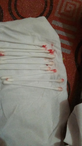 Hai bunda apakah pernah mengalami apa yang di alami oleh saya...saya batuk keluar darah dari telinga
