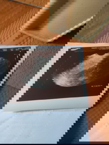 No embryo? Normal ba?