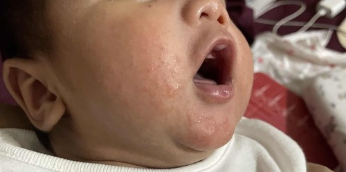 ผดผื่นเด็กอ่อน