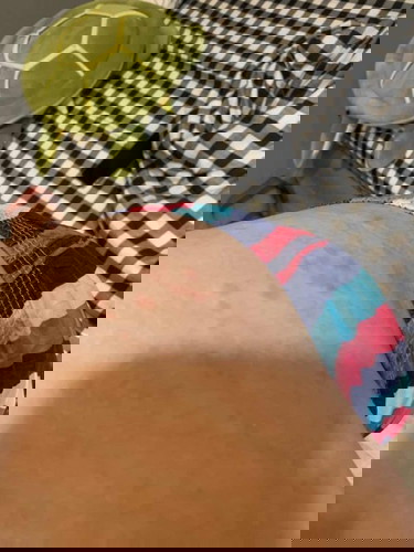 ผื่นแบบนี้เกิดจากอะไรคะ