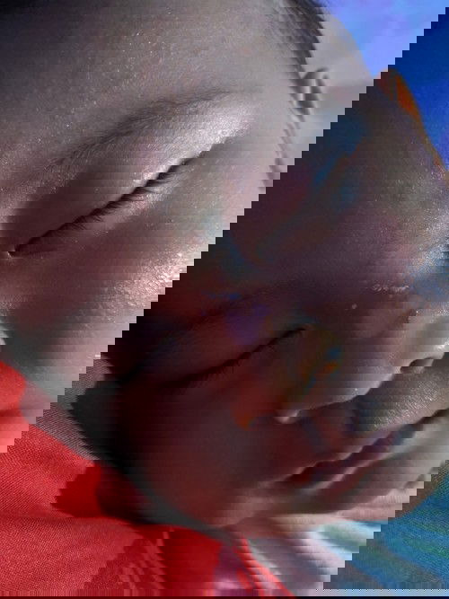 Bagaimana cara mengatasi luka bakar baby