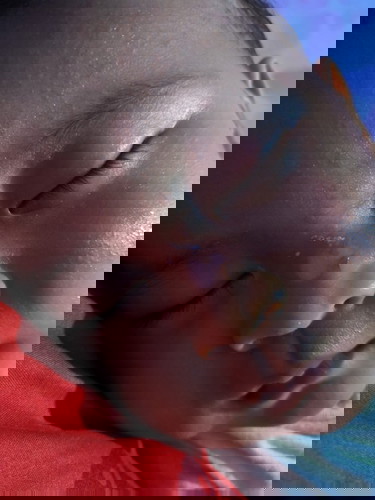 Bagaimana cara mengatasi luka bakar baby