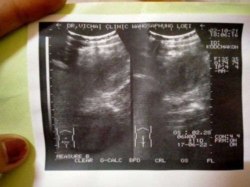 อยากรู้ว่าใช่ท้องลมใหม รึท้องปกติ😢ถ้าท้องปกติจะได้รีบบำรุง