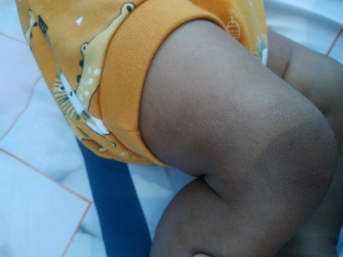 Kulit kaki dan tangan tidak merata