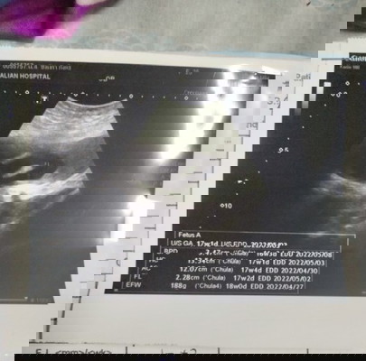 ขอสอบถามหน่อยค่ะน้ำหนักน้องในครรภ์ 188G มากไปหรือน้อยไปคะ