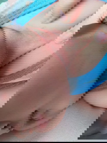 pahelp or pa suggest naman po gamot sa rashes nato? na try na namin calmoseptine wala ayaw pden🙁