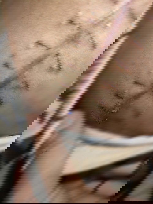 มี่ไหมออกมาจากฝีเย็บแผลผ่าคลอด