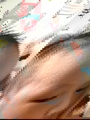 ผื่นขึ้นศรีษะและหน้าผาก