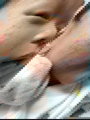 ผดผื่น😢😢