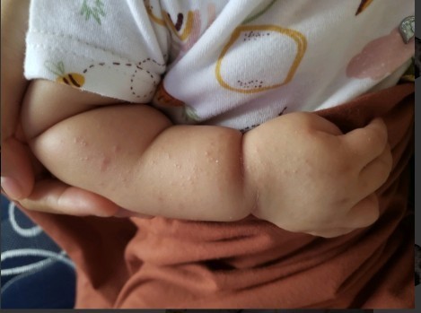 Bintik Merah Pada Bayi