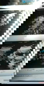 ปากแหว่งเพดานโหว่