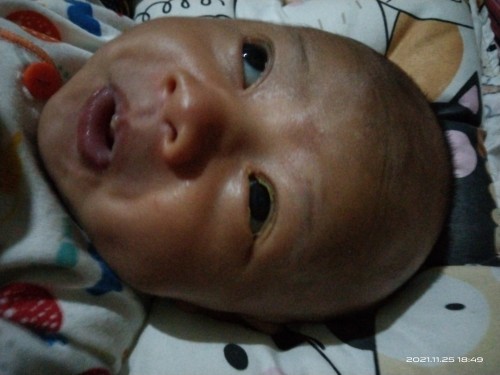 Mata belekan pada bayi