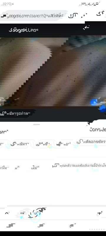 คลอดแล้วเป็นสิวที่หลังและหน้าอกไม่หายเป็นสิวฮอร์โมนก่อนคลอด