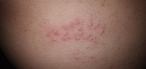 Heat Rash (bungang araw) or PUPPP rash?