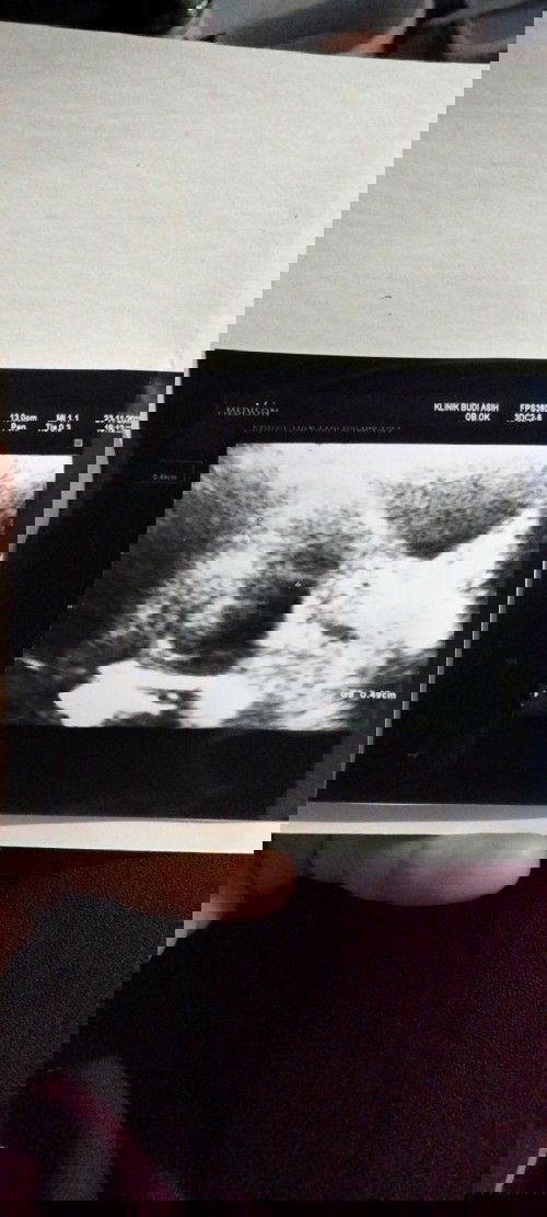 Bismillah semoga ada yg berkenan menjawab ..
Bun kemaren aku USG cuma ada gs nya aja ngga ada gA nya