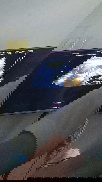 #21W2day ไปลุ้นเพศแต่ลูกไม่ยอมให้ดู🤍🤍