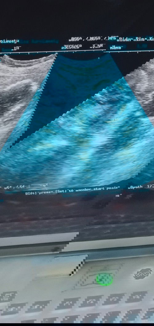 posisi plasenta di bawah