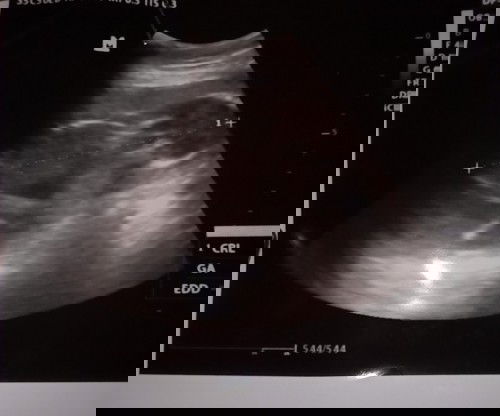 Vaksin covid19 bumil