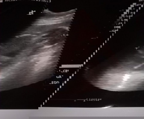 Vaksin covid19 bumil