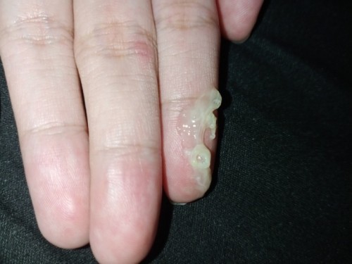 mucus plug o normal discharge?