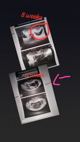 Fetus 1 is dead
Fetus 2 is alive