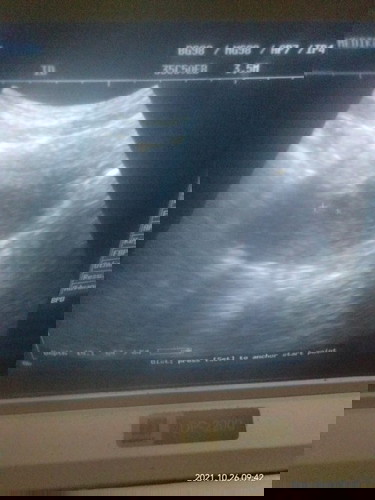 Apa sudah terlihan janin atau kantong janin nya