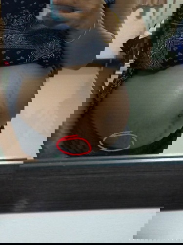 ปวดท้องด้านขวา