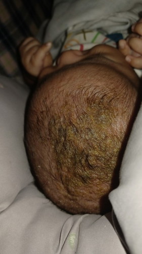 ไขที่หัวลูก