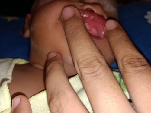 Putih2 di mulut bayi