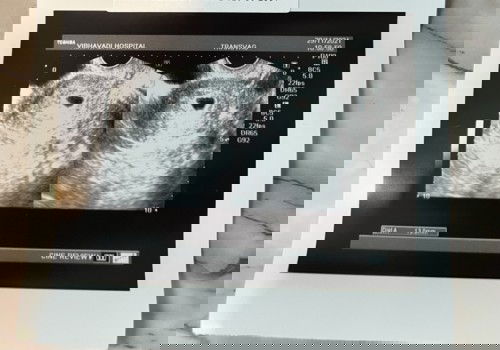 ตั้งครรภ์ 9 w ไปซาวน์ ยังไม่เจอตัวอ่อน แบบนี้หมดหวังรึยังค่ะ