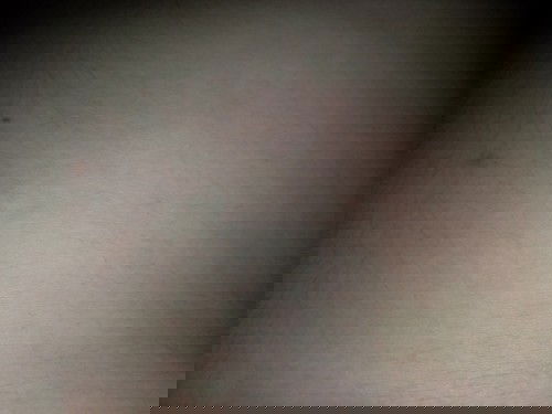 แม่ๆบ้านไหนขึ้นผื่นบ้างคะ