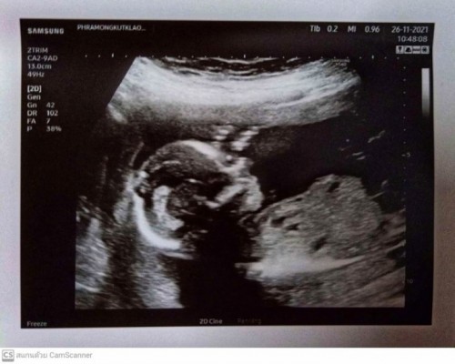 ไม่ว่านู๋จะเป็นผู้หญิงหรือผู้ชายแม่ก็รักนะคะ ( 19+2week ) ทีมเมษาคะ