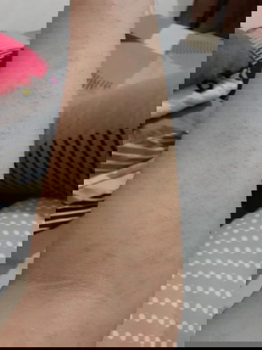 Gatal dan ruam saat hamil 36 minggu