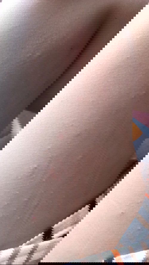 Pangangati pagkatapos manganak