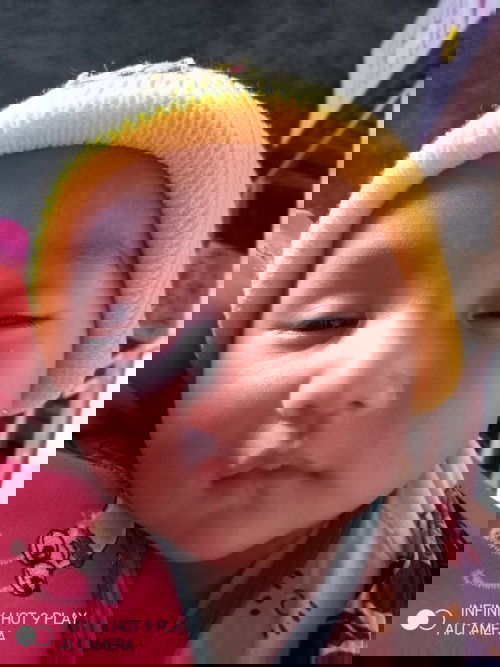 Cara menghilangkan ruam susu bagaimana