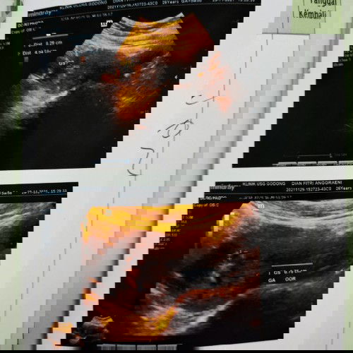 Tespek garis ll tapi d USG belum kelihatan kantongnya