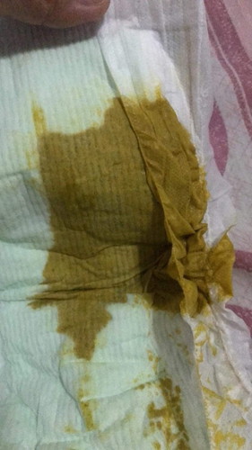 น้องถ่ายเหลวค่ะ